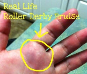 bruise